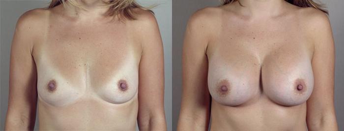 Breast Augmentation Case 415 Before & After View #1 | Paramus, New Jersey | Parker Center for Plastic Surgery