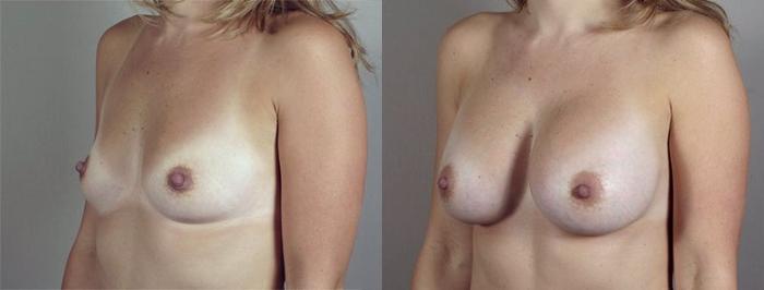 Breast Augmentation Case 415 Before & After View #2 | Paramus, New Jersey | Parker Center for Plastic Surgery