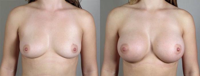 Breast Augmentation Case 416 Before & After View #1 | Paramus, New Jersey | Parker Center for Plastic Surgery