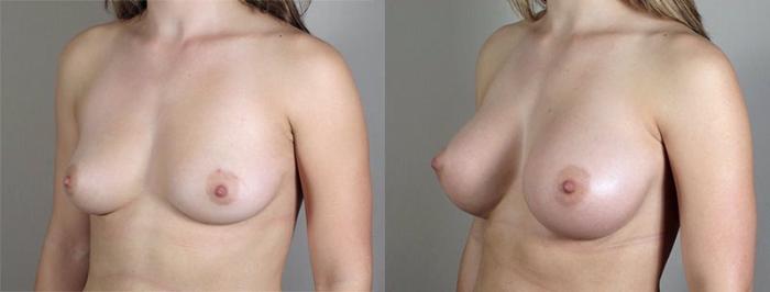 Breast Augmentation Case 416 Before & After View #2 | Paramus, New Jersey | Parker Center for Plastic Surgery