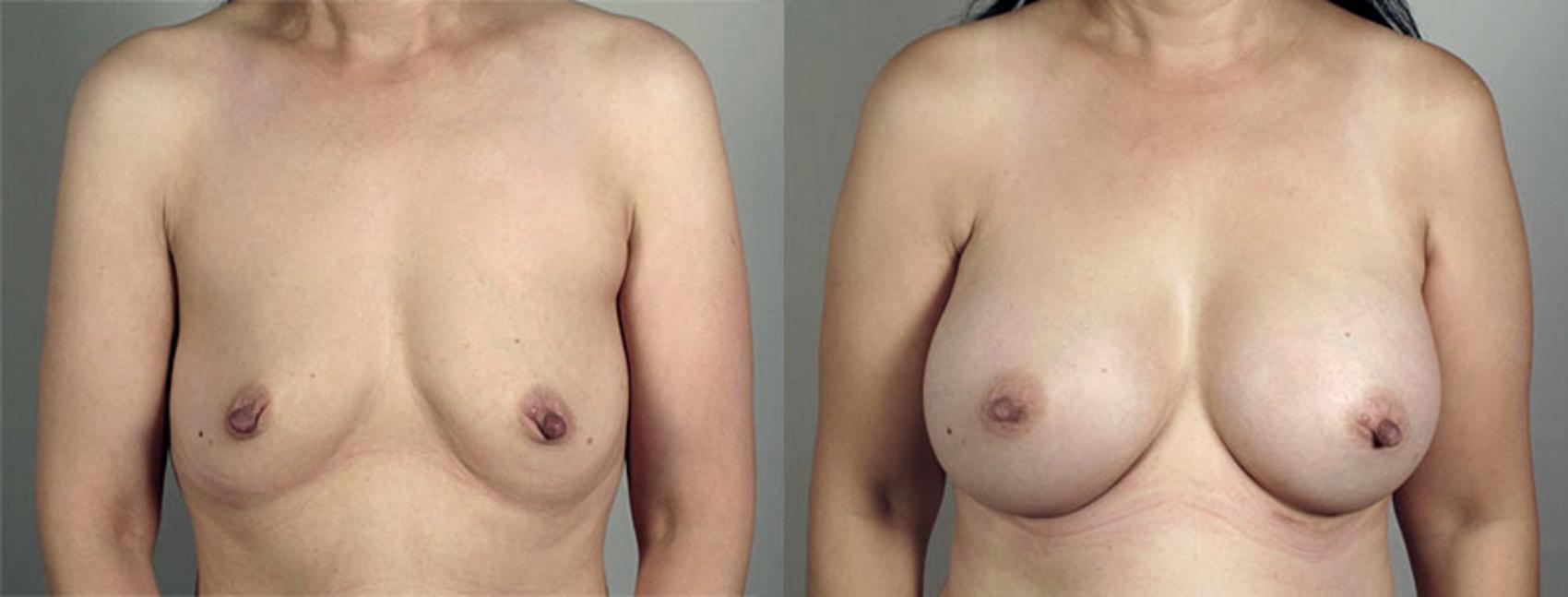 Breast Augmentation Case 417 Before & After View #1 | Paramus, New Jersey | Parker Center for Plastic Surgery
