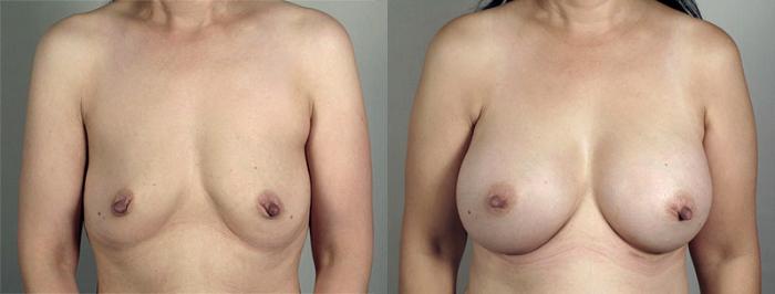 Breast Augmentation Case 417 Before & After View #1 | Paramus, New Jersey | Parker Center for Plastic Surgery