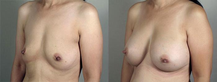 Breast Augmentation Case 417 Before & After View #2 | Paramus, New Jersey | Parker Center for Plastic Surgery