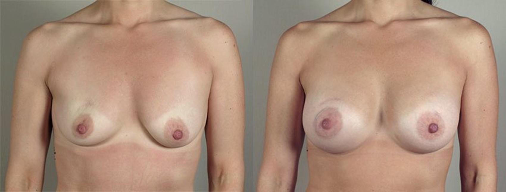 Breast Augmentation Case 418 Before & After View #1 | Paramus, New Jersey | Parker Center for Plastic Surgery