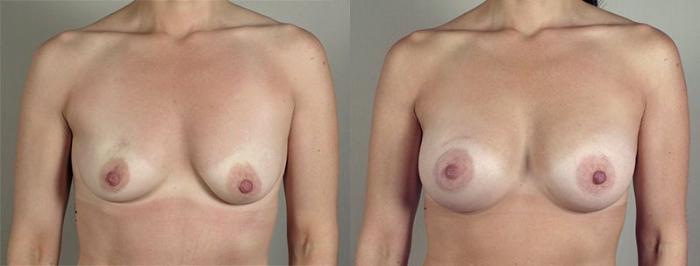 Breast Augmentation Case 418 Before & After View #1 | Paramus, New Jersey | Parker Center for Plastic Surgery