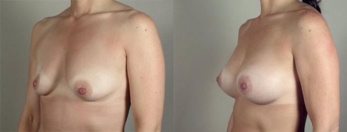 Breast Augmentation Case 418 Before & After View #2 | Paramus, New Jersey | Parker Center for Plastic Surgery