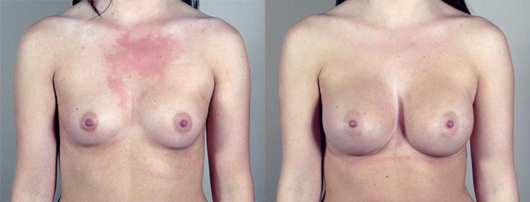 Breast Augmentation Case 419 Before & After View #1 | Paramus, New Jersey | Parker Center for Plastic Surgery
