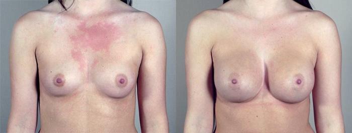 Breast Augmentation Case 419 Before & After View #1 | Paramus, New Jersey | Parker Center for Plastic Surgery