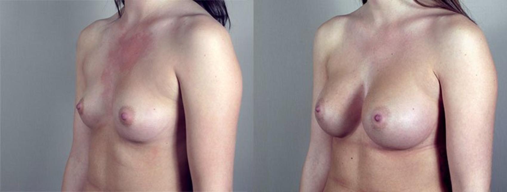 Breast Augmentation Case 419 Before & After View #2 | Paramus, New Jersey | Parker Center for Plastic Surgery