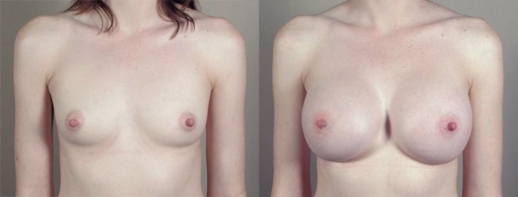 Breast Augmentation Case 420 Before & After View #1 | Paramus, New Jersey | Parker Center for Plastic Surgery