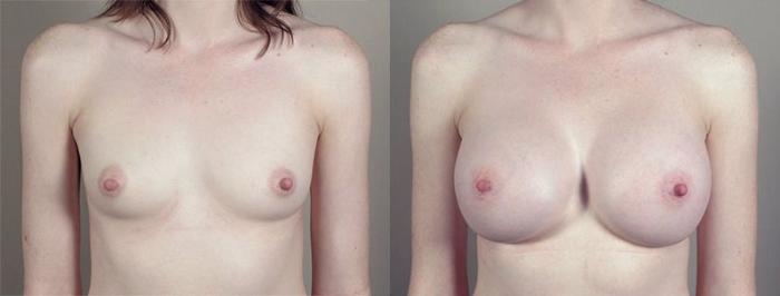 Breast Augmentation Case 420 Before & After View #1 | Paramus, New Jersey | Parker Center for Plastic Surgery