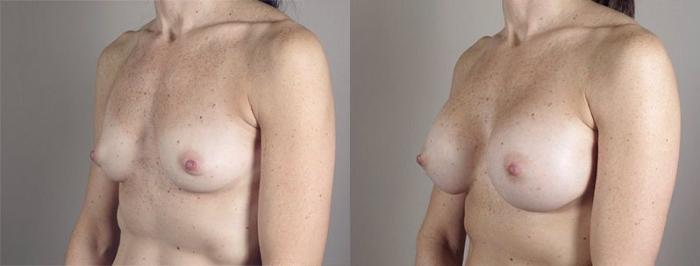 Breast Augmentation Case 421 Before & After View #2 | Paramus, New Jersey | Parker Center for Plastic Surgery