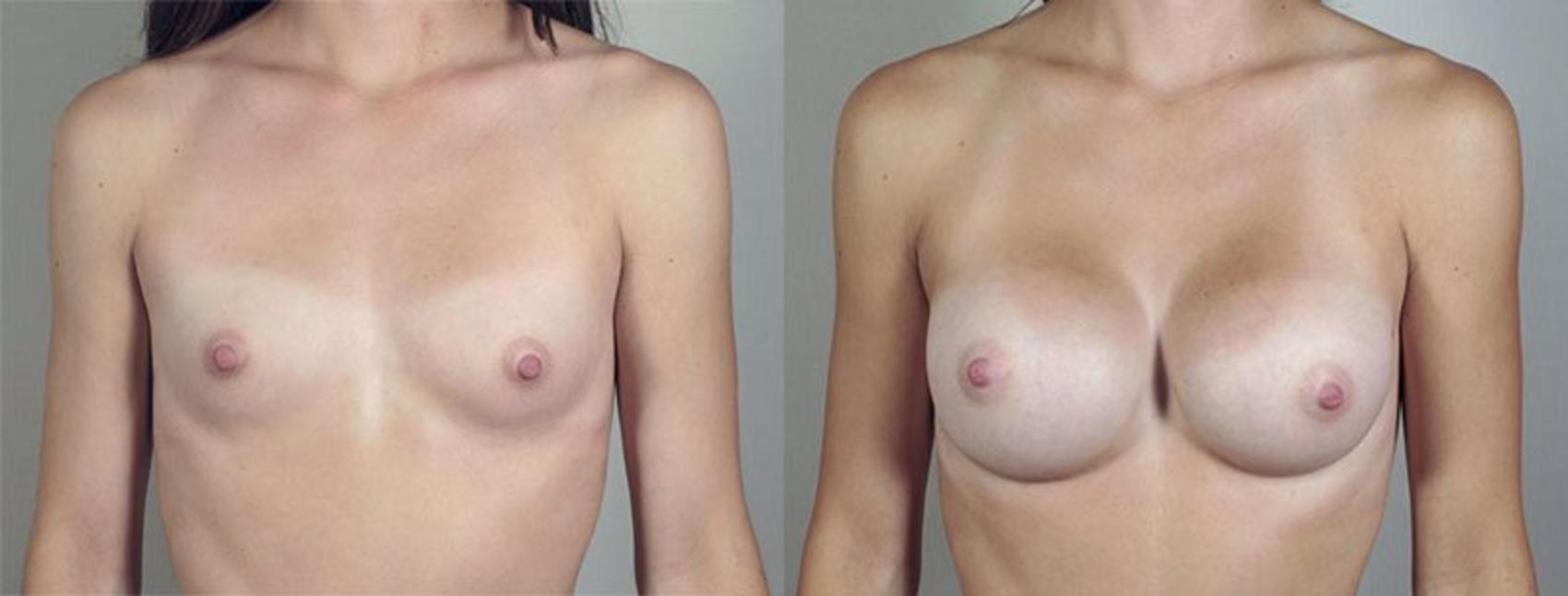 Breast Augmentation Case 422 Before & After View #1 | Paramus, New Jersey | Parker Center for Plastic Surgery