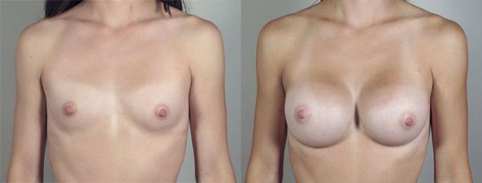 Breast Augmentation Case 422 Before & After View #1 | Paramus, New Jersey | Parker Center for Plastic Surgery