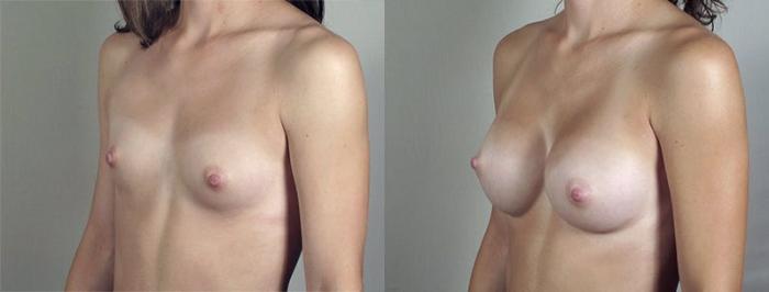Breast Augmentation Case 422 Before & After View #2 | Paramus, New Jersey | Parker Center for Plastic Surgery