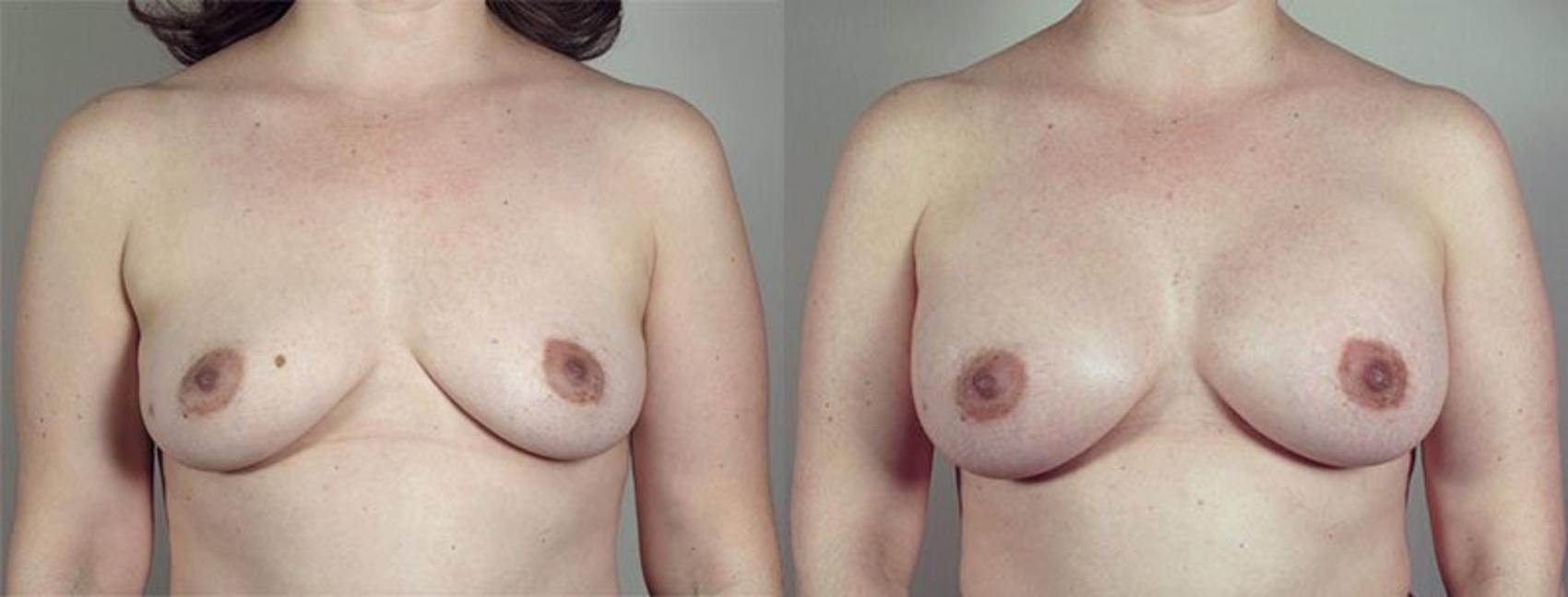 Breast Augmentation Case 423 Before & After View #1 | Paramus, New Jersey | Parker Center for Plastic Surgery