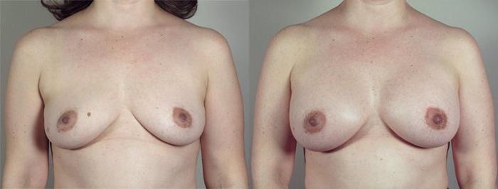 Breast Augmentation Case 423 Before & After View #1 | Paramus, New Jersey | Parker Center for Plastic Surgery