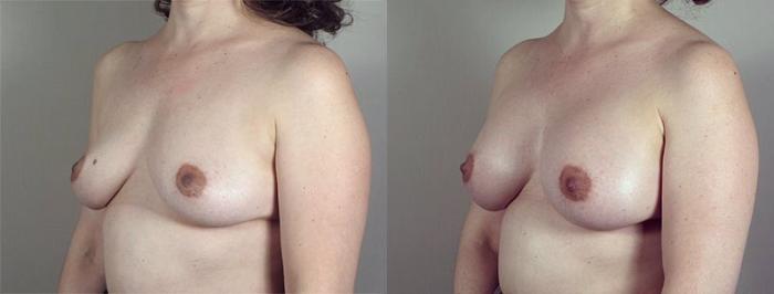 Breast Augmentation Case 423 Before & After View #2 | Paramus, New Jersey | Parker Center for Plastic Surgery