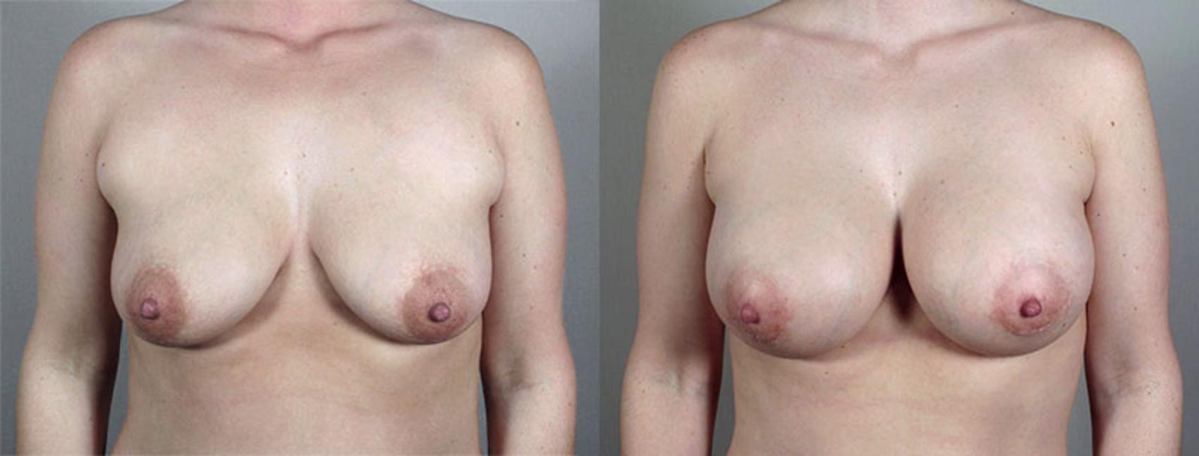 Breast Augmentation Case 424 Before & After View #1 | Paramus, New Jersey | Parker Center for Plastic Surgery