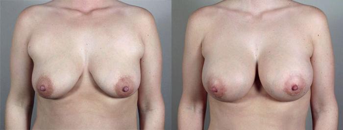Breast Augmentation Case 424 Before & After View #1 | Paramus, New Jersey | Parker Center for Plastic Surgery
