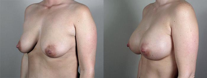 Breast Augmentation Case 424 Before & After View #2 | Paramus, New Jersey | Parker Center for Plastic Surgery
