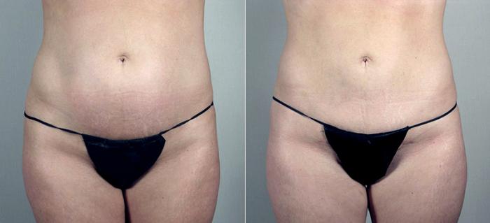 Breast Augmentation Case 424 Before & After View #3 | Paramus, New Jersey | Parker Center for Plastic Surgery