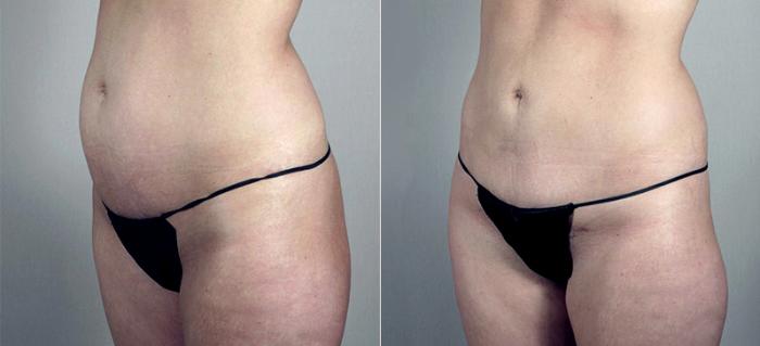 Breast Augmentation Case 424 Before & After View #4 | Paramus, New Jersey | Parker Center for Plastic Surgery