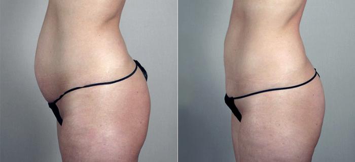 Breast Augmentation Case 424 Before & After View #5 | Paramus, New Jersey | Parker Center for Plastic Surgery