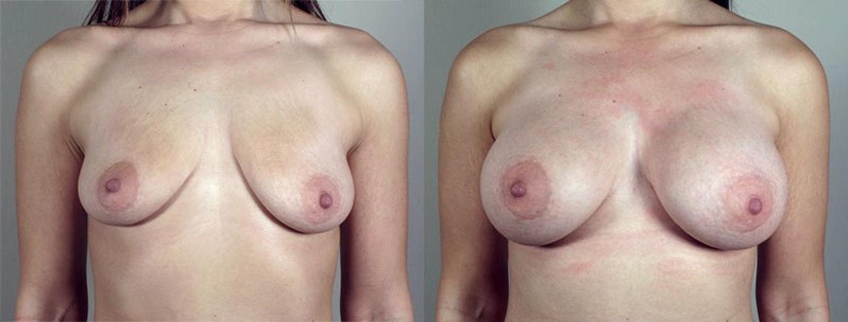 Breast Augmentation Case 425 Before & After View #1 | Paramus, New Jersey | Parker Center for Plastic Surgery