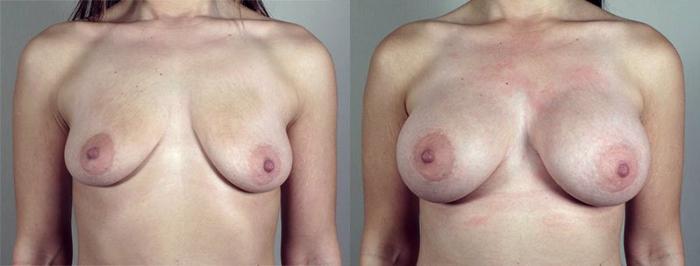 Breast Augmentation Case 425 Before & After View #1 | Paramus, New Jersey | Parker Center for Plastic Surgery