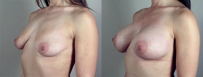 Breast Augmentation Case 425 Before & After View #2 | Paramus, New Jersey | Parker Center for Plastic Surgery