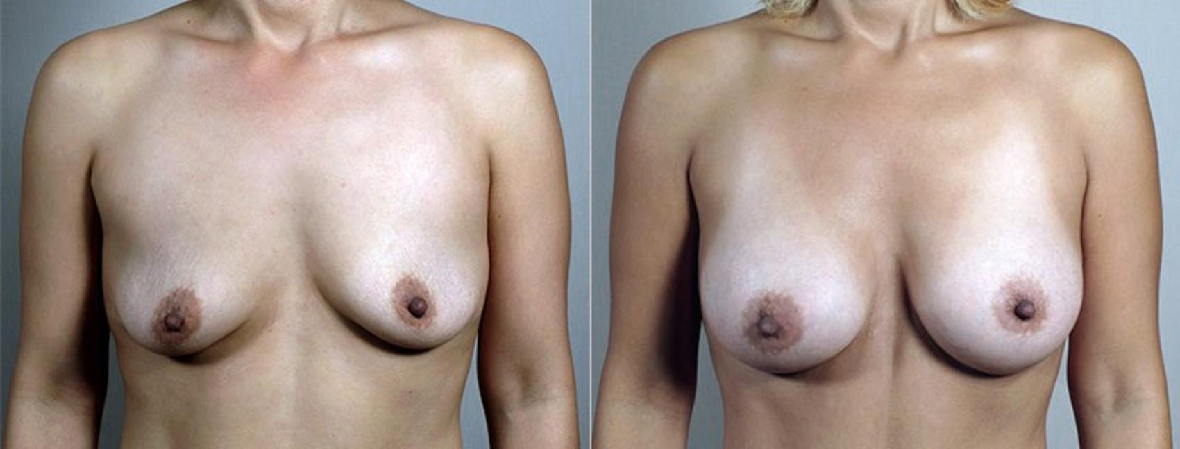 Breast Augmentation Case 427 Before & After View #1 | Paramus, New Jersey | Parker Center for Plastic Surgery