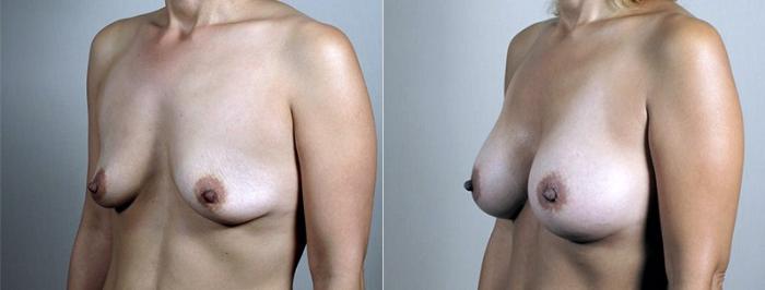 Breast Augmentation Case 427 Before & After View #2 | Paramus, New Jersey | Parker Center for Plastic Surgery