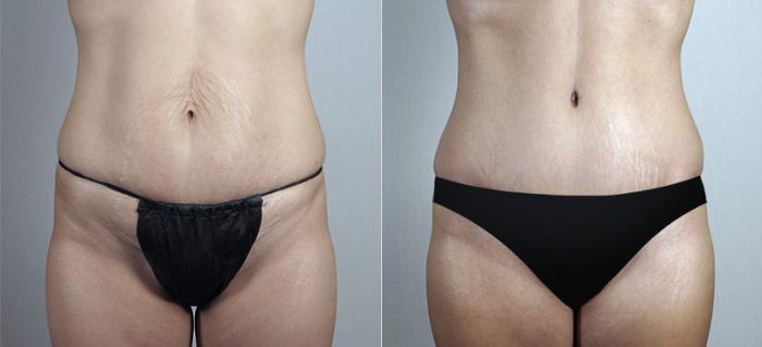 Breast Augmentation Case 427 Before & After View #3 | Paramus, New Jersey | Parker Center for Plastic Surgery