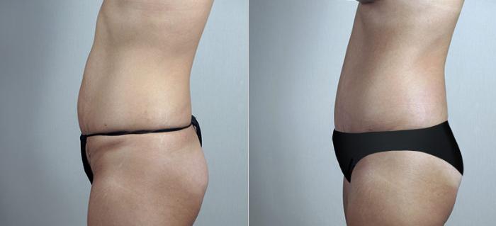 Breast Augmentation Case 427 Before & After View #4 | Paramus, New Jersey | Parker Center for Plastic Surgery