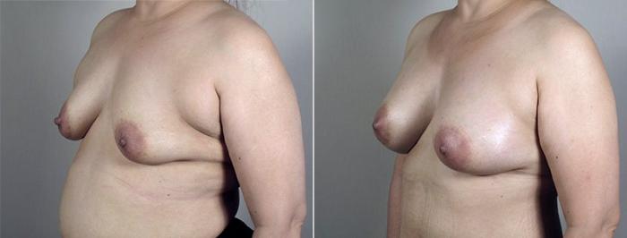 Breast Augmentation Case 428 Before & After View #2 | Paramus, New Jersey | Parker Center for Plastic Surgery