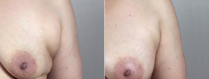 Breast Augmentation Case 428 Before & After View #3 | Paramus, New Jersey | Parker Center for Plastic Surgery