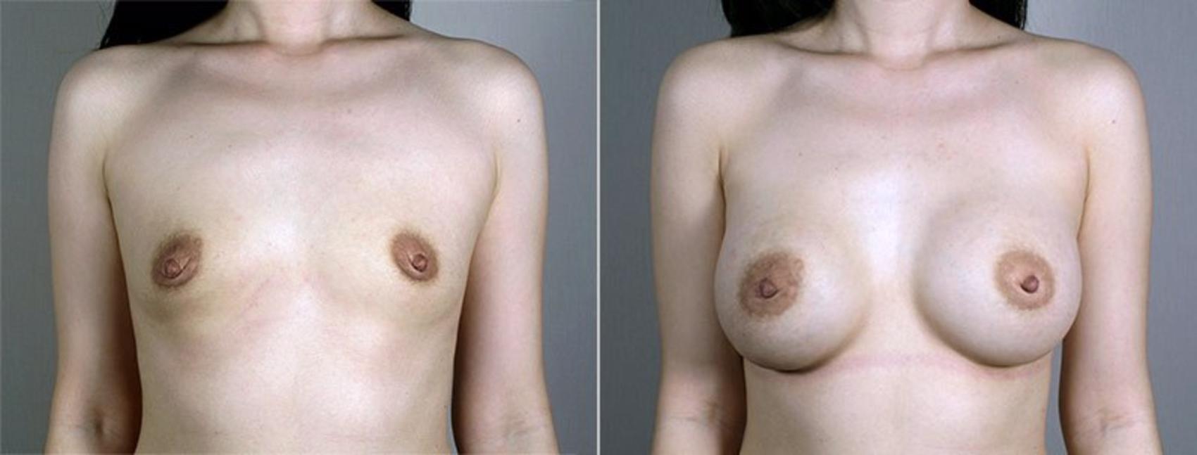 Breast Augmentation Case 430 Before & After View #1 | Paramus, New Jersey | Parker Center for Plastic Surgery