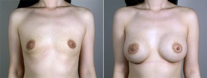 Breast Augmentation Case 430 Before & After View #1 | Paramus, New Jersey | Parker Center for Plastic Surgery