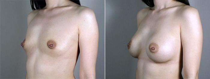 Breast Augmentation Case 430 Before & After View #2 | Paramus, New Jersey | Parker Center for Plastic Surgery