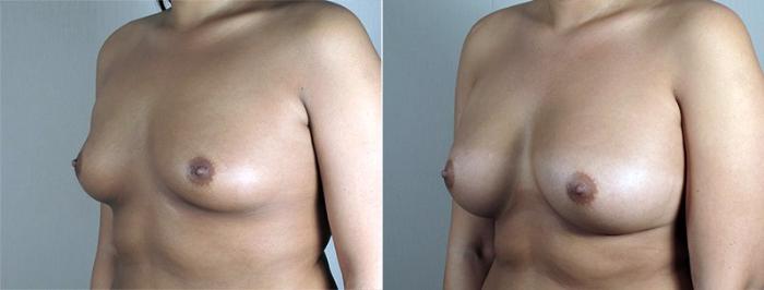 Breast Augmentation Case 431 Before & After View #1 | Paramus, New Jersey | Parker Center for Plastic Surgery
