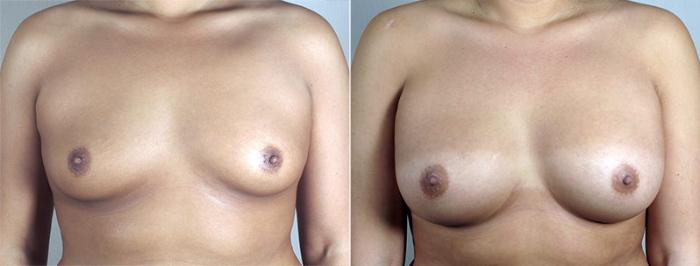 Breast Augmentation Case 431 Before & After View #2 | Paramus, New Jersey | Parker Center for Plastic Surgery