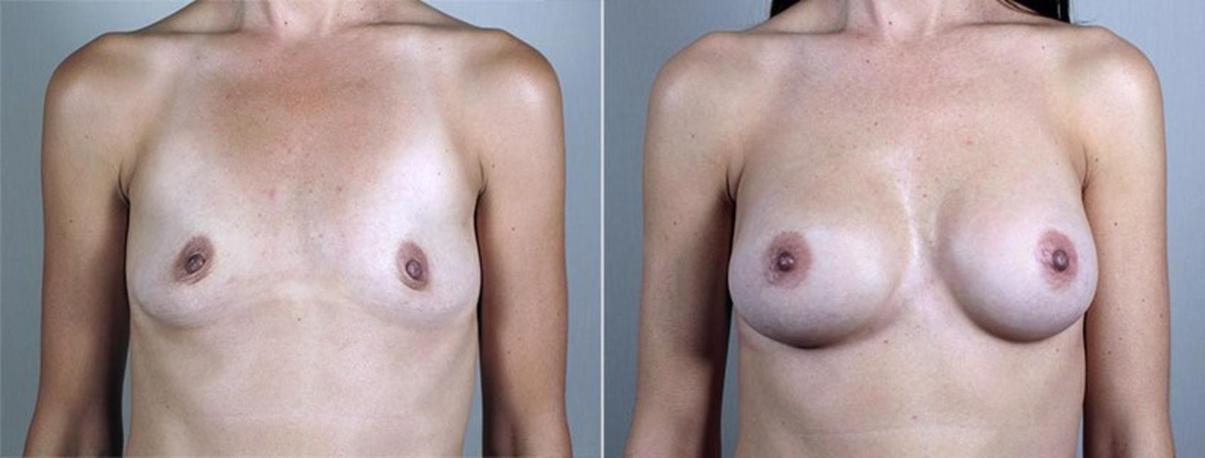 Breast Augmentation Case 432 Before & After View #1 | Paramus, New Jersey | Parker Center for Plastic Surgery