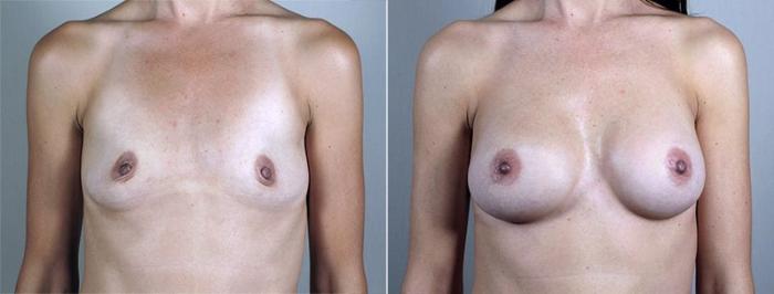 Breast Augmentation Case 432 Before & After View #1 | Paramus, New Jersey | Parker Center for Plastic Surgery