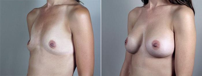 Breast Augmentation Case 432 Before & After View #2 | Paramus, New Jersey | Parker Center for Plastic Surgery