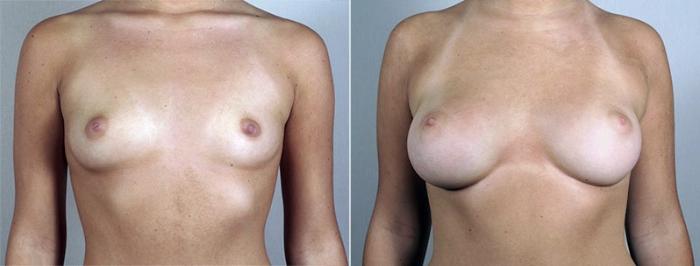 Breast Augmentation Case 433 Before & After View #1 | Paramus, New Jersey | Parker Center for Plastic Surgery