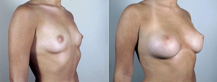 Breast Augmentation Case 433 Before & After View #2 | Paramus, New Jersey | Parker Center for Plastic Surgery