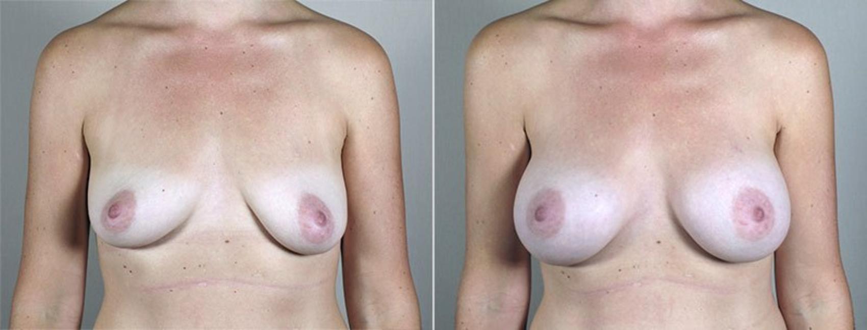 Breast Augmentation Case 434 Before & After View #1 | Paramus, New Jersey | Parker Center for Plastic Surgery