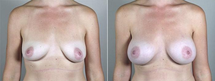 Breast Augmentation Case 434 Before & After View #1 | Paramus, New Jersey | Parker Center for Plastic Surgery