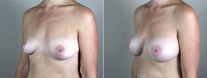 Breast Augmentation Case 434 Before & After View #2 | Paramus, New Jersey | Parker Center for Plastic Surgery